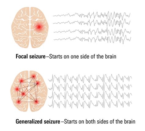 Types of Seizures