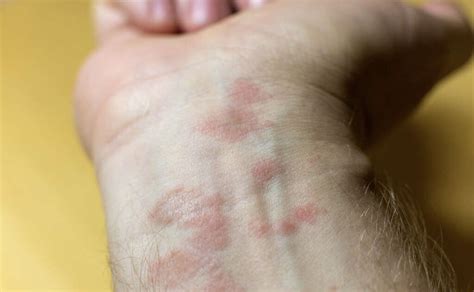 Discoid Eczema: 10 Symptoms Of Discoid Eczema