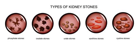 Male Signs of Kidney Stones | STD.GOV Blog