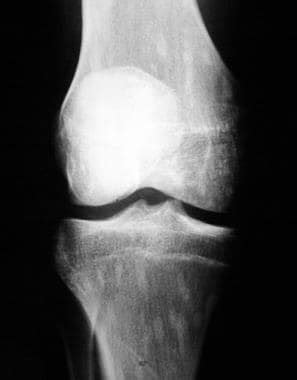 Bone Island Imaging: Practice Essentials, Radiography, Computed Tomography