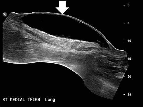 Morel-Lavallee Lesion Initially Diagnosed as Quadriceps Contusion: Ultrasound, MRI, and ...