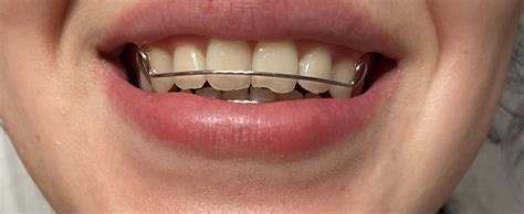 Is my metal retainer supposed to fit like this? : r/braces