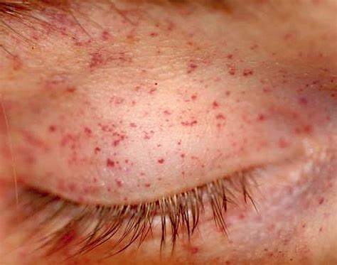 Petechial Rash | Good Health