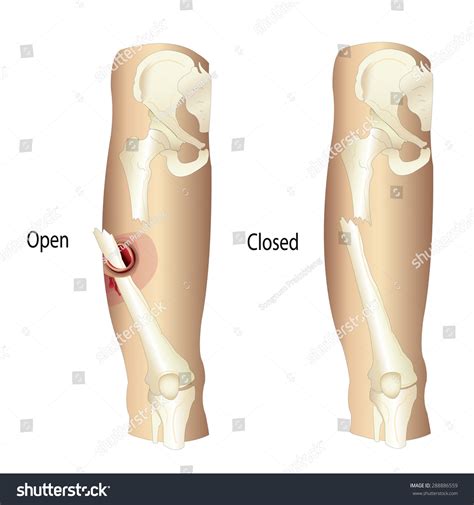 4,432 Open Fracture Images, Stock Photos & Vectors | Shutterstock