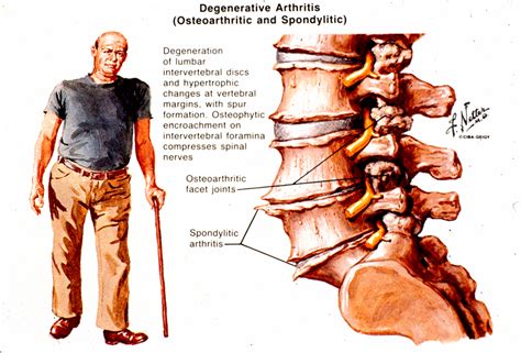 Arthritis of The Spine | Arthritis In Back Symptoms