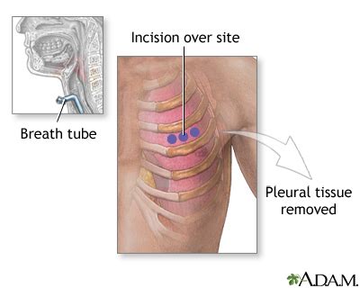 Incision for pleural tissue biopsy: MedlinePlus Medical Encyclopedia Image