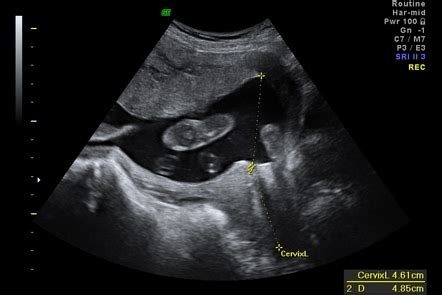 dating scan at 8 weeks