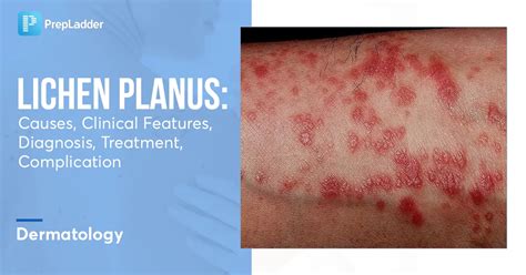 Lichen Planus: Causes, Clinical Features, Diagnosis