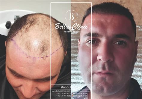 Hair Transplant Reviews Turkey 2024 - Hair Transplant Turkey vs Europe