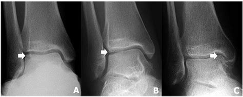 Talar dome lesion (OCD) - DocMartins Foot & Ankle Clinics