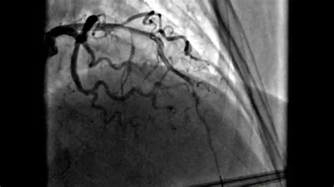 Heart stent procedure - YouTube