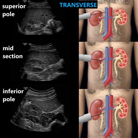 Kidney Ultrasound