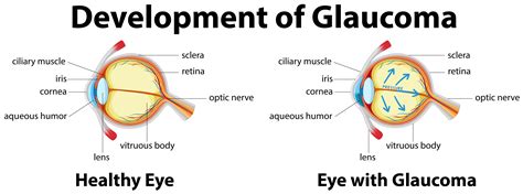 Development of Glaucoma in human eyes 418715 Vector Art at Vecteezy