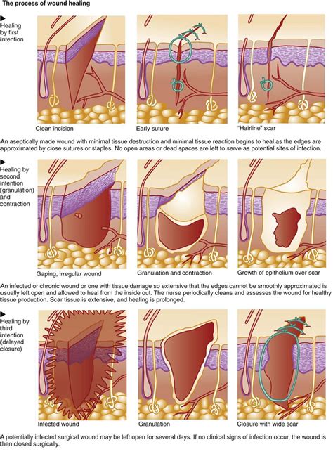 Care of Patients with Skin Problems | Nurse Key