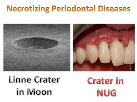 Necrotising periodontal diseases