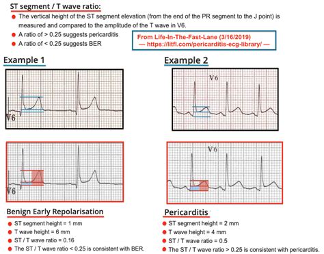 Acute Pericarditis Ecg Changes