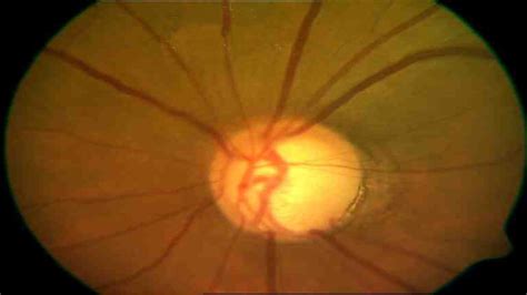 PHFI CEHJ » Diagnosing glaucoma