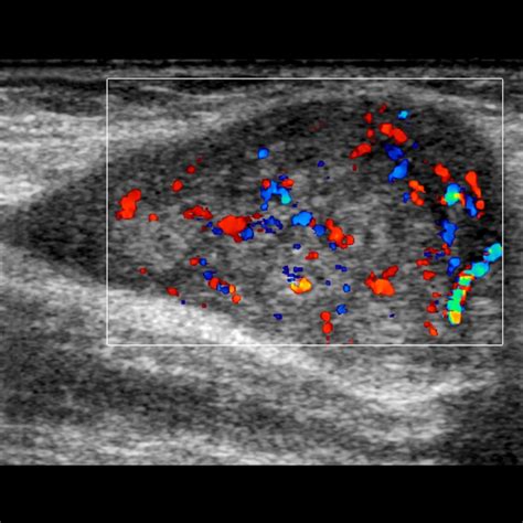 Nerve Sheath Tumors | Radiology Key