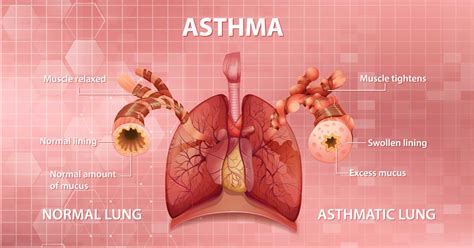 What are the current treatments for asthma?