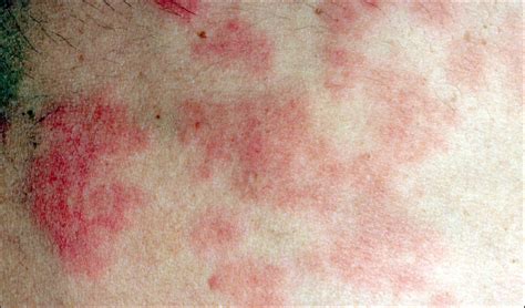 Sun Poisoning Rash - Pictures, Symptoms, Causes and Treatment