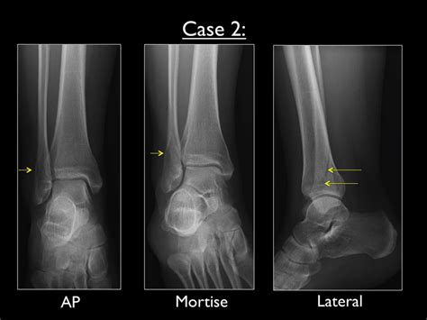 AP, Mortise and lateral view of the right ankle in case 2. Yellow... | Download Scientific Diagram