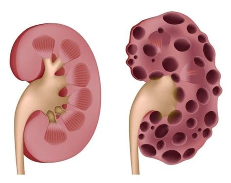 Kidney Cysts - familydoctor.org