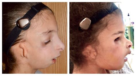 craniofacial treatment and services | Dayton Children's