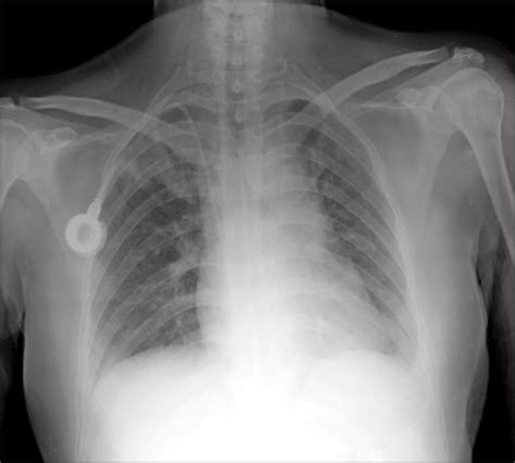 Chest X-ray showing a suspicious consolidation in the r | Open-i