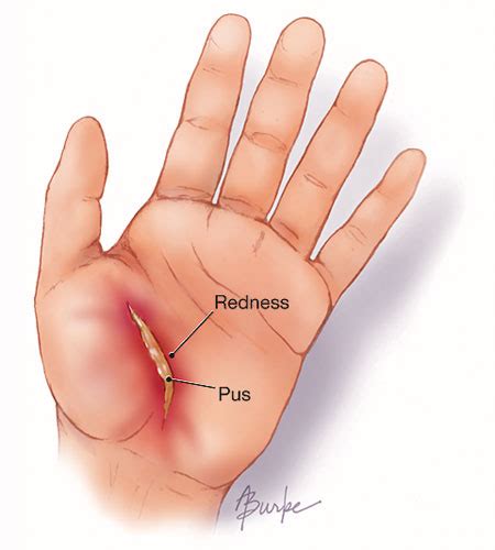 Wound Infections | Infectious Diseases | JAMA | The JAMA Network