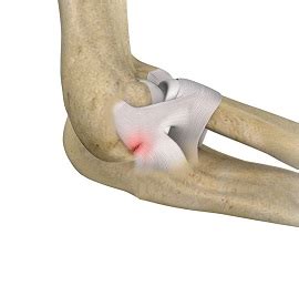 Lateral Ulnar Collateral Ligament Injuries (Elbow) | Advanced Orthopaedics & Sports Medicine ...