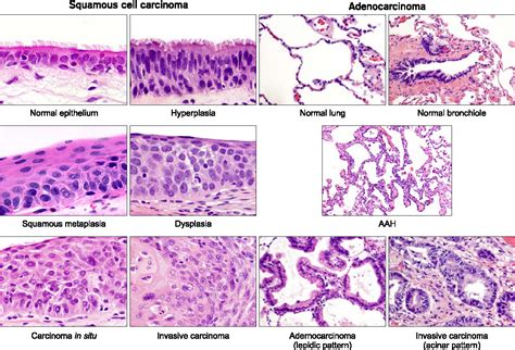 Squamous Cell Carcinoma Lung Histology