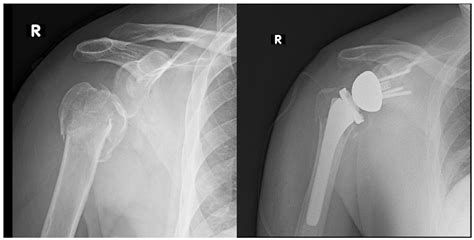 JCM | Free Full-Text | The Evolution of Reverse Total Shoulder ...