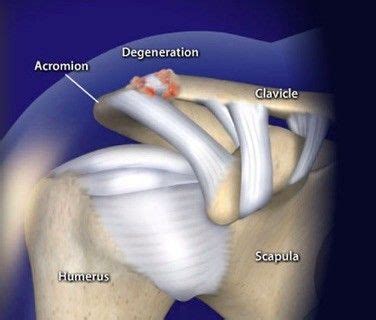 This condition, also called AC joint arthrosis, is a degeneration of ...