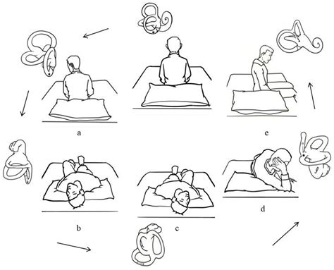 Frontiers | Self-Treatment of Posterior Canal Benign Paroxysmal Positional Vertigo: A ...