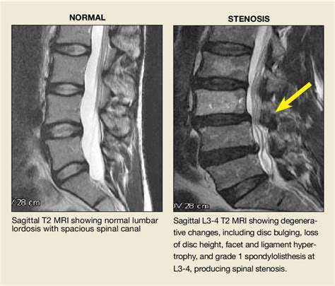 Lumbar Spine Mri Lumbar Spinal Stenosis Mri Spinal Stenosis Lumbar | My XXX Hot Girl