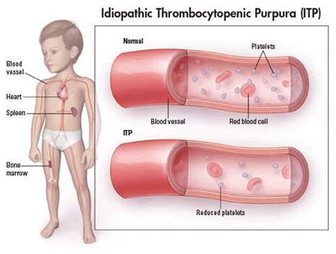 Idiopathic Thrombocytopenic Purpura Nursing Care Management - Nurseslabs