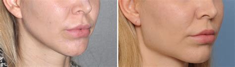 Plastic Surgery Case Study - Female Jaw Angle Implants for a More ...