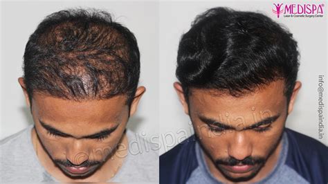 Wrong Hair Transplant Correction Before After Result India