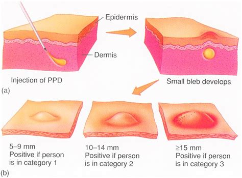 Tuberculosis Test - PPD Skin Test, Blood Test, How It Work