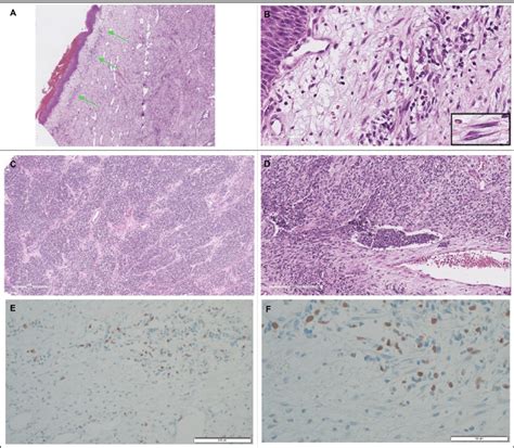 Pathology slides for Case #2. A. Sarcoma botryoides (4x): The cambium ...