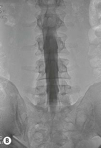 Spinal Interventions | Radiology Key