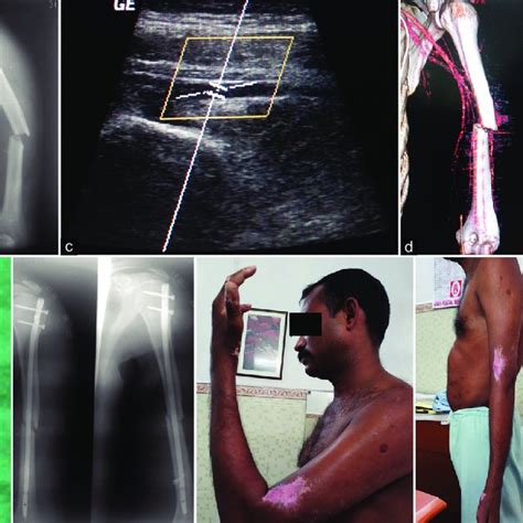 Kocher maneuver. During the Kocher maneuver the patient lies in a... | Download Scientific Diagram