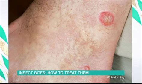 Horsefly bite: Signs of insect bite revealed by This Morning Dr Ranj ...