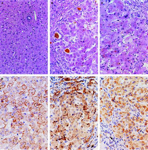 Abnormalities in villin gene expression and canalicular microvillus structure in progressive ...