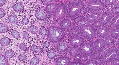 Tubulovillous Adenoma Colon