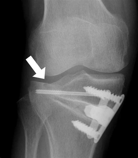 The complications of high tibial osteotomy | Bone & Joint