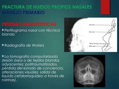 FRACTURA DE HUESOS NASALES - DR. OMAR GONZALES SUAZO.