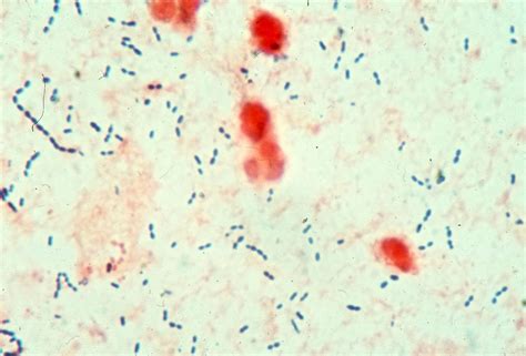 Streptococcus pneumoniae - Microbiology - Medbullets Step 1