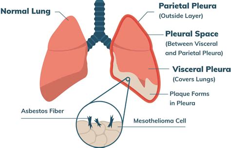 Malignant Mesothelioma Cancer | Stages, Prognosis, Treatment