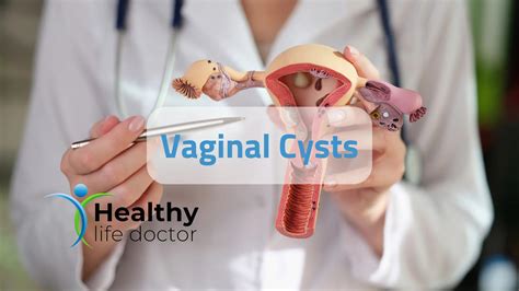 Vaginal Cysts | The Best Way To Diagnose And Treat 2024